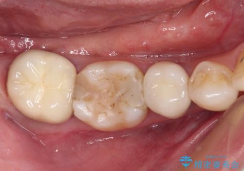 奥歯がしみる　色々な国で治療を受けてきた奥歯のむし歯治療の治療前