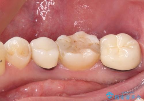奥歯がしみる　色々な国で治療を受けてきた奥歯のむし歯治療の治療前