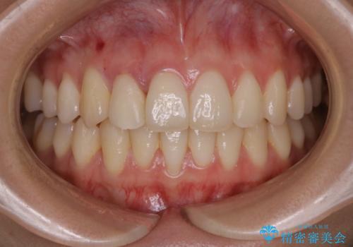 非抜歯でも劇的変化　インビザライン矯正治療の症例 治療後