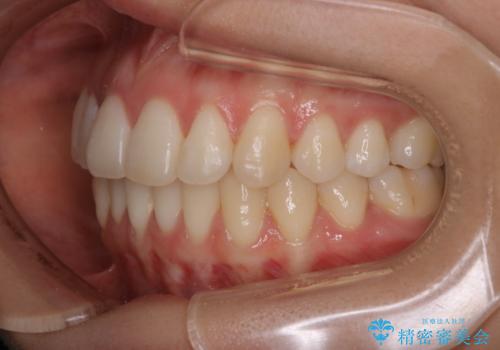非抜歯でも劇的変化　インビザライン矯正治療の治療後