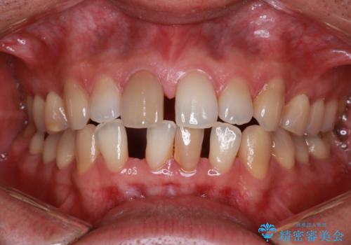 【前歯の隙間】インビザラインですきっ歯の矯正治療の症例 治療前