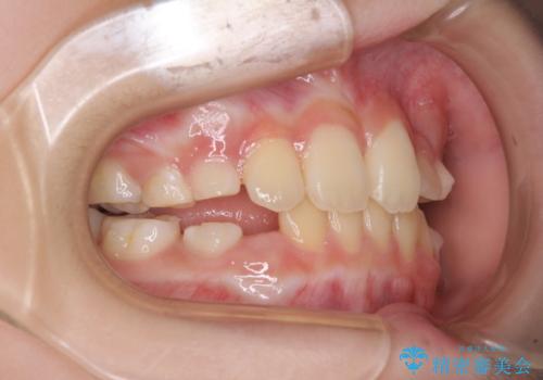 過剰歯を抜歯して前歯を排列　インビザライン・ファーストによる小学生のⅠ期治療の治療中