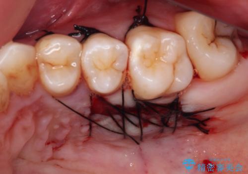 ほぼ歯根全てが露出　2度の歯肉移植術で自然な見た目にの治療前
