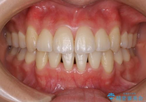 八重歯がスッキリ　抜歯ワイヤー矯正の症例 治療後