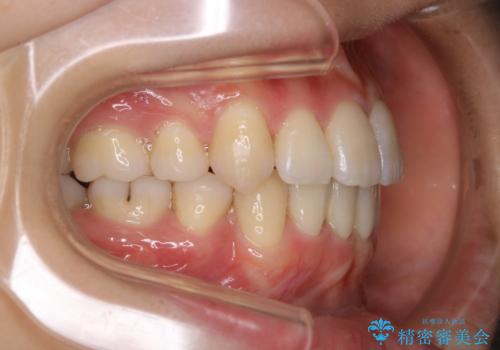 八重歯がスッキリ　抜歯ワイヤー矯正の治療後