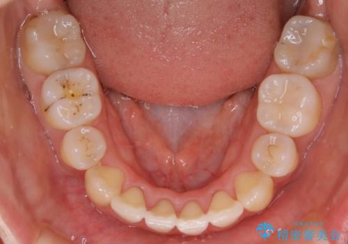 八重歯がスッキリ　抜歯ワイヤー矯正の治療後