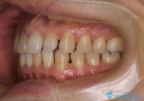 【前歯の隙間】インビザラインですきっ歯の矯正治療の治療中