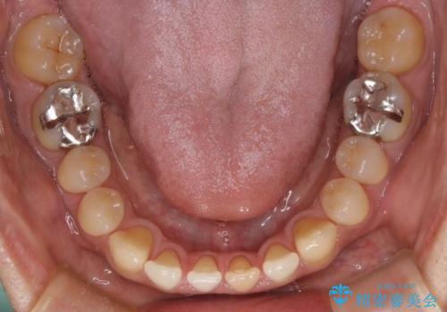 【前歯の隙間】インビザラインですきっ歯の矯正治療の治療中