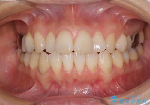 気になる前歯をインビザライン・ライトで　矯正治療後には銀歯をセラミックにの症例 治療前