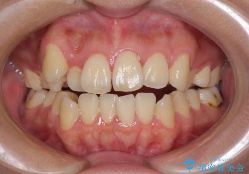 補助装置を使ったインビザラインによる抜歯矯正の症例 治療前