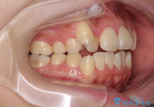補助装置を使ったインビザラインによる抜歯矯正の治療前