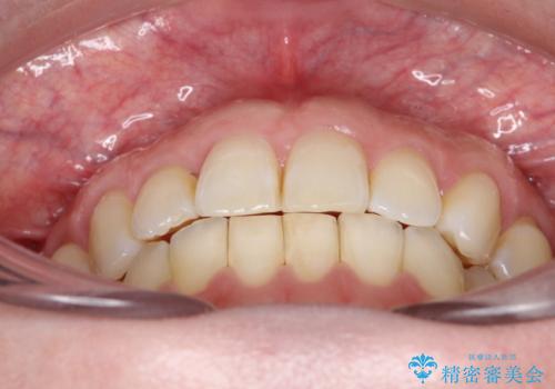 上の歯と下の歯が反対にかんでいる　インビザラインによる目立たない矯正の治療後
