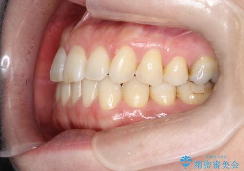 上の歯と下の歯が反対にかんでいる　インビザラインによる目立たない矯正の治療後