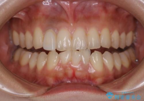 前歯1本をセラミック(被せ物)にする前に、全体的に白くしていくオフィスホワイトニングの治療前