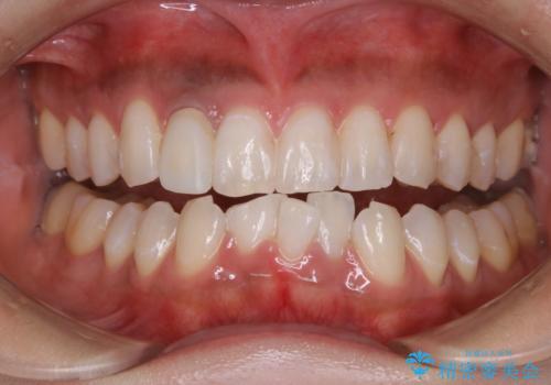 前歯1本をセラミック(被せ物)にする前に、全体的に白くしていくオフィスホワイトニングの治療後
