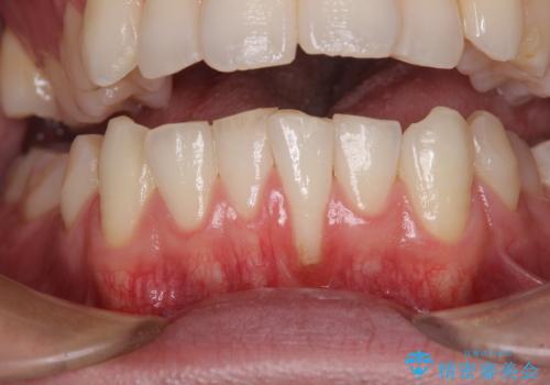 ほぼ歯根全てが露出　2度の歯肉移植術で自然な見た目にの症例 治療前