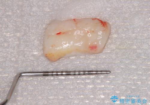 ほぼ歯根全てが露出　2度の歯肉移植術で自然な見た目にの治療中