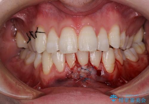 ほぼ歯根全てが露出　2度の歯肉移植術で自然な見た目にの治療中