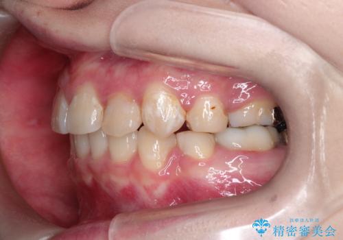 八重歯が気になる　ワイヤーによる抜歯矯正できれいな歯並びへの治療後