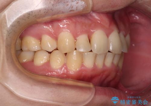 強い咬み込みですり減った前歯　デコボコを抜歯矯正で整えるの治療後