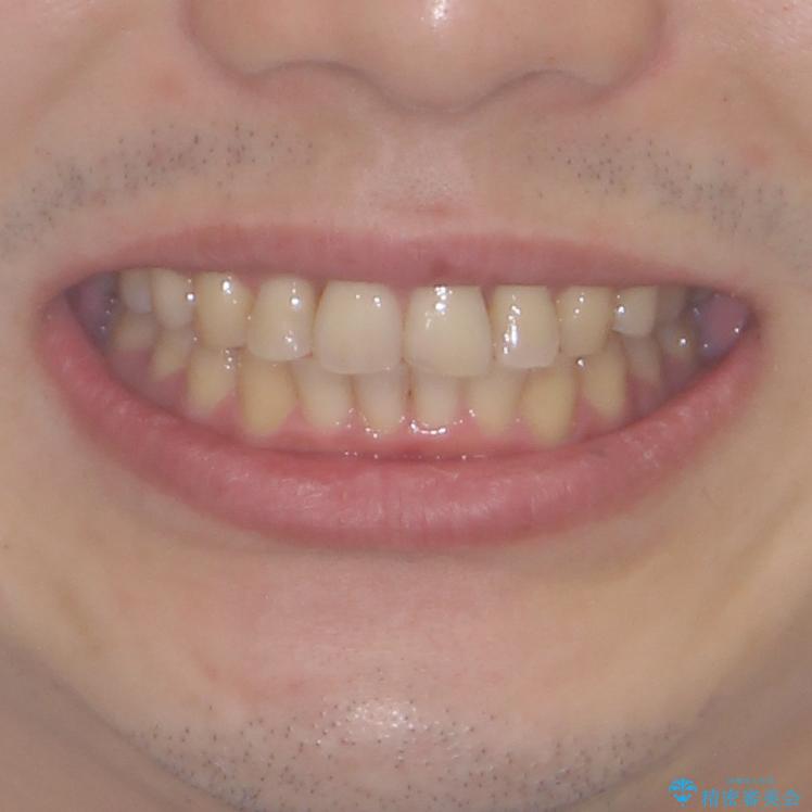 強い咬み込みですり減った前歯　デコボコを抜歯矯正で整えるの治療後（顔貌）