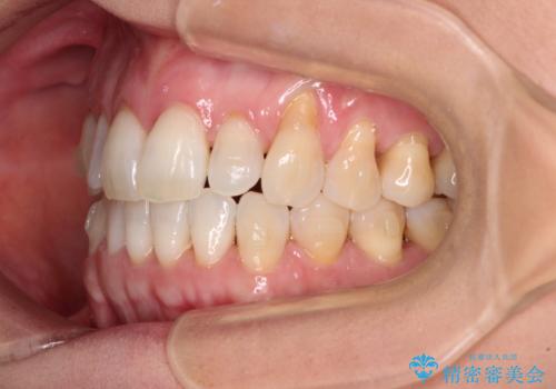 前歯のスペースが気になる　インビザラインによる矯正治療の治療中