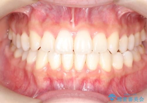軽度の前歯のガタガタをインビザラインでの目立たない矯正の症例 治療後