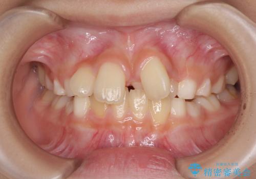 過剰歯を抜歯して前歯を排列　インビザライン・ファーストによる小学生のⅠ期治療の症例 治療前