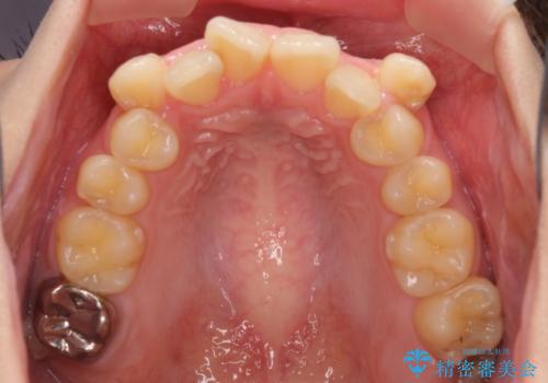 上顎の八重歯と下顎前歯の欠損　ワイヤー装置による抜歯矯正の治療前