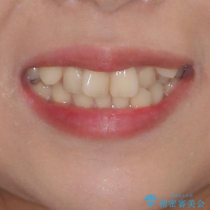 上顎の八重歯と下顎前歯の欠損　ワイヤー装置による抜歯矯正の治療前（顔貌）