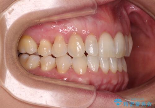 前歯のスペースが気になる　インビザラインによる矯正治療の治療後