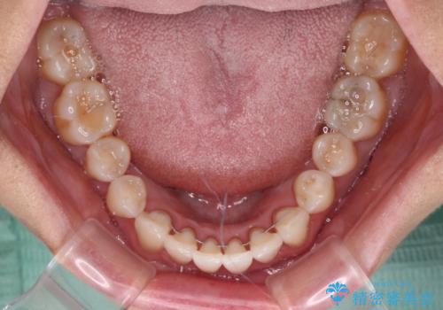 前歯のスペースが気になる　インビザラインによる矯正治療の治療後