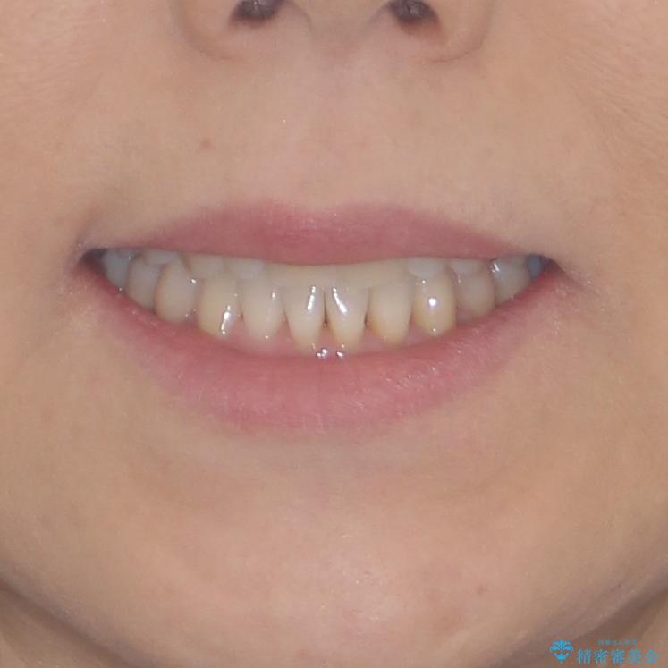 前歯のスペースが気になる　インビザラインによる矯正治療の治療後（顔貌）