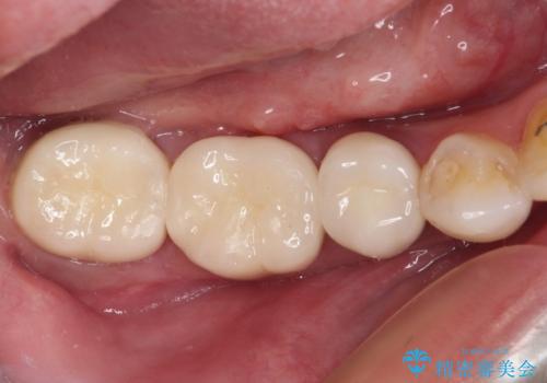 奥歯がしみる　色々な国で治療を受けてきた奥歯のむし歯治療の治療後