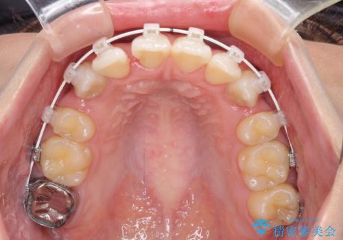 上顎の八重歯と下顎前歯の欠損　ワイヤー装置による抜歯矯正の治療中