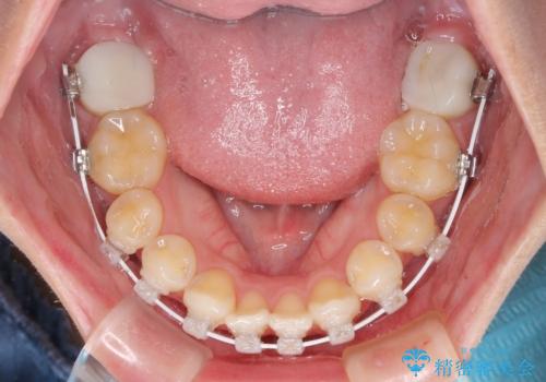 上顎の八重歯と下顎前歯の欠損　ワイヤー装置による抜歯矯正の治療中