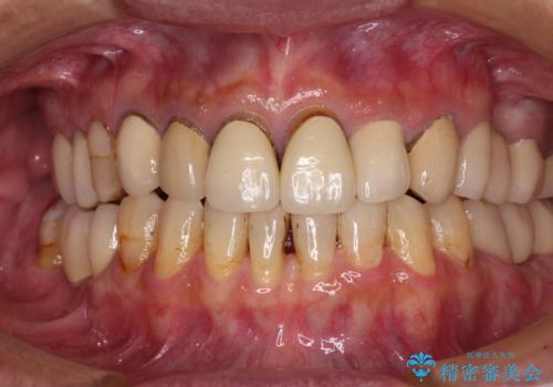 空隙歯列弓(すきっ歯)の症例 治療後