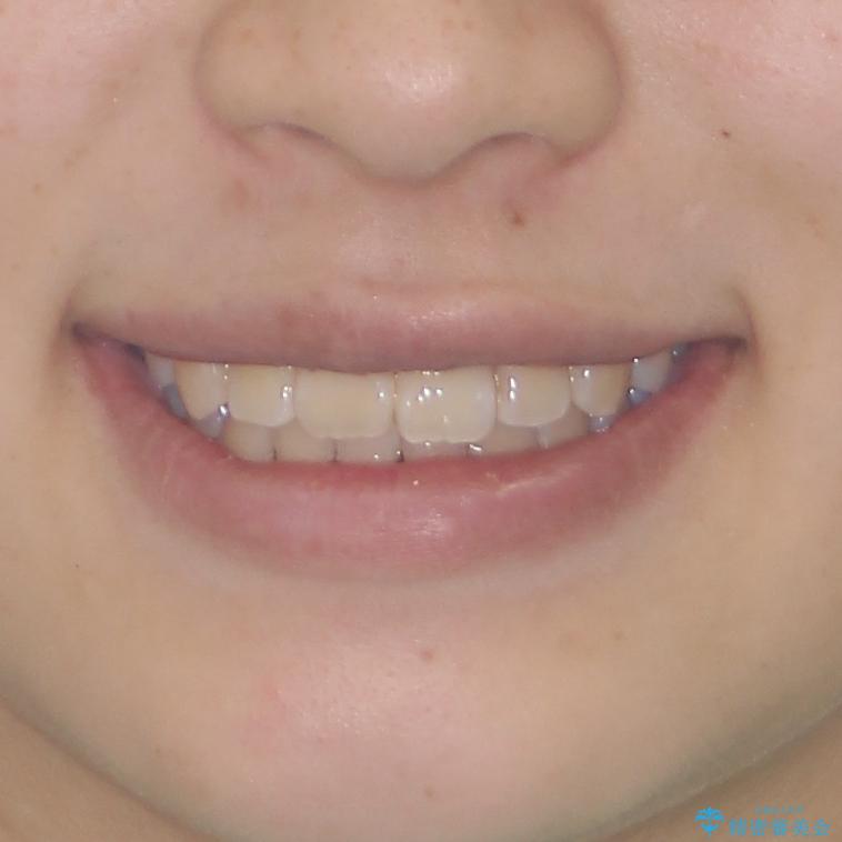 八重歯で正中が右にずれている　ワイヤー装置での抜歯矯正で正中位置を改善の治療後（顔貌）
