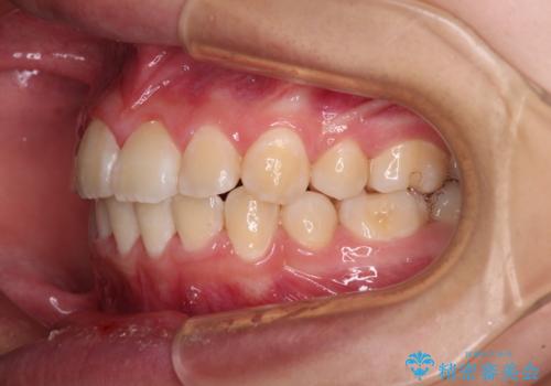 八重歯で正中が右にずれている　ワイヤー装置での抜歯矯正で正中位置を改善の治療後