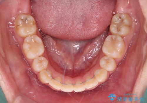 八重歯で正中が右にずれている　ワイヤー装置での抜歯矯正で正中位置を改善の治療後