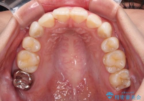 上顎の八重歯と下顎前歯の欠損　ワイヤー装置による抜歯矯正の治療後