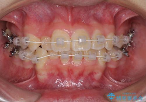 八重歯で正中が右にずれている　ワイヤー装置での抜歯矯正で正中位置を改善の治療中