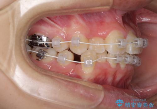 八重歯で正中が右にずれている　ワイヤー装置での抜歯矯正で正中位置を改善の治療中