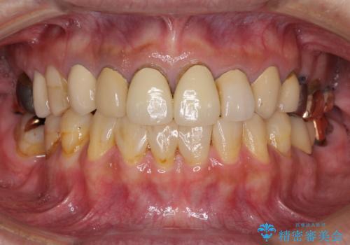 空隙歯列弓(すきっ歯)の症例 治療前