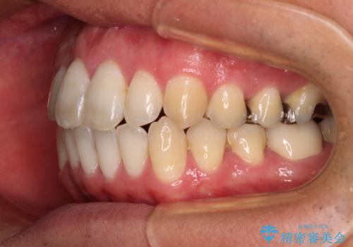 咬み合わせが気になる　ワイヤー矯正による咬み合わせ改善と奥歯のセラミック治療の治療後
