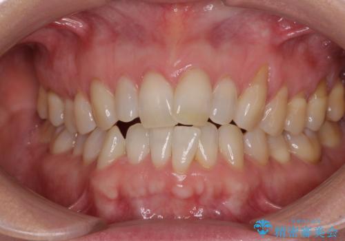 前歯のスペースが気になる　インビザラインによる矯正治療の症例 治療前