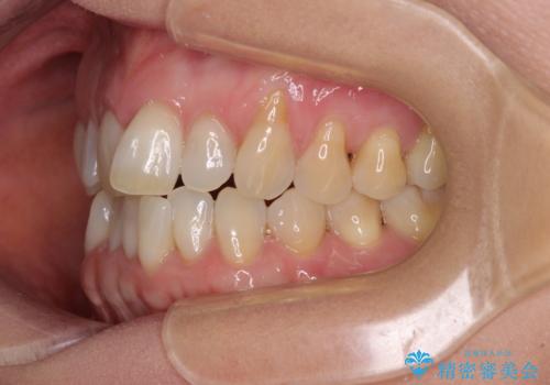 前歯のスペースが気になる　インビザラインによる矯正治療の治療前