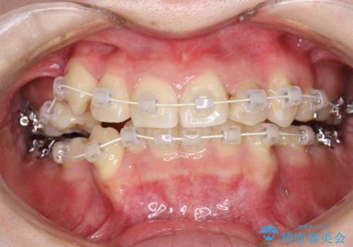 八重歯が気になる　ワイヤーによる抜歯矯正できれいな歯並びへの治療中