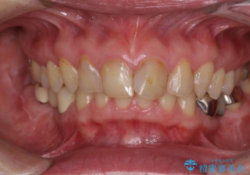 奥歯インプラントの症例 治療前