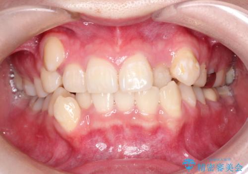八重歯が気になる　ワイヤーによる抜歯矯正できれいな歯並びへの症例 治療前